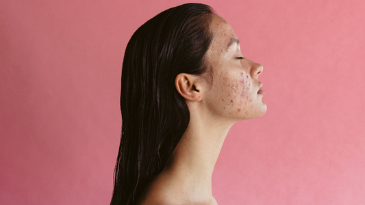 Habit Hack: Effective Ways to Address and Prevent Adult Acne