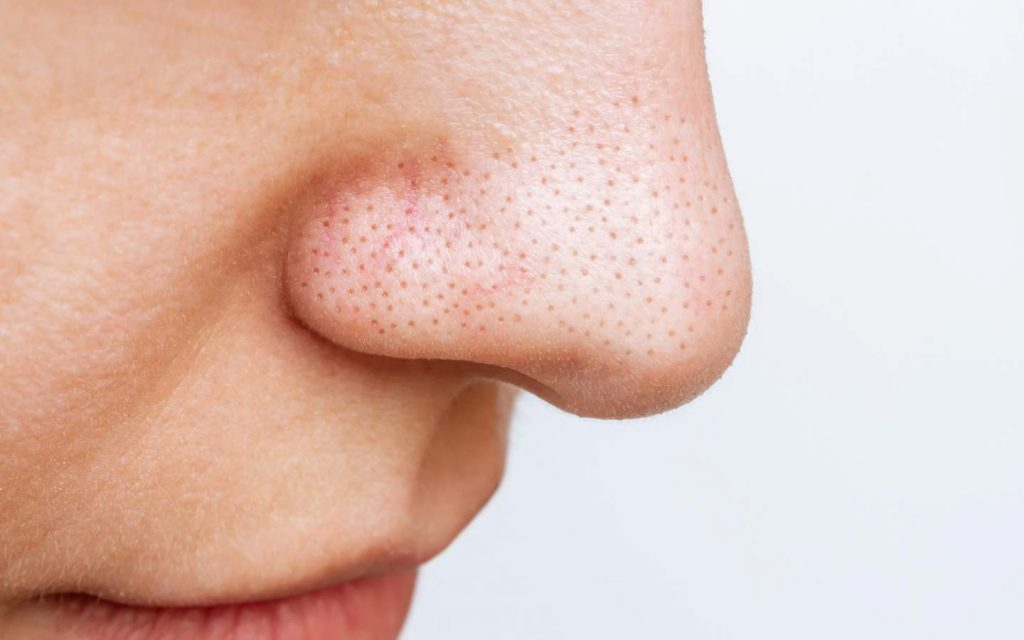 Duo Guide: Understanding Large Pores and How to Refine Them – DuoGen