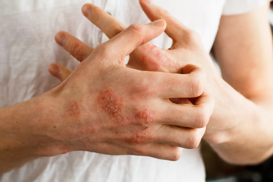 Habit Hack: How to Combat Seasonal Eczema Flare-Ups