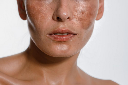 Habit Hack: Combatting Post-Summer Hyperpigmentation